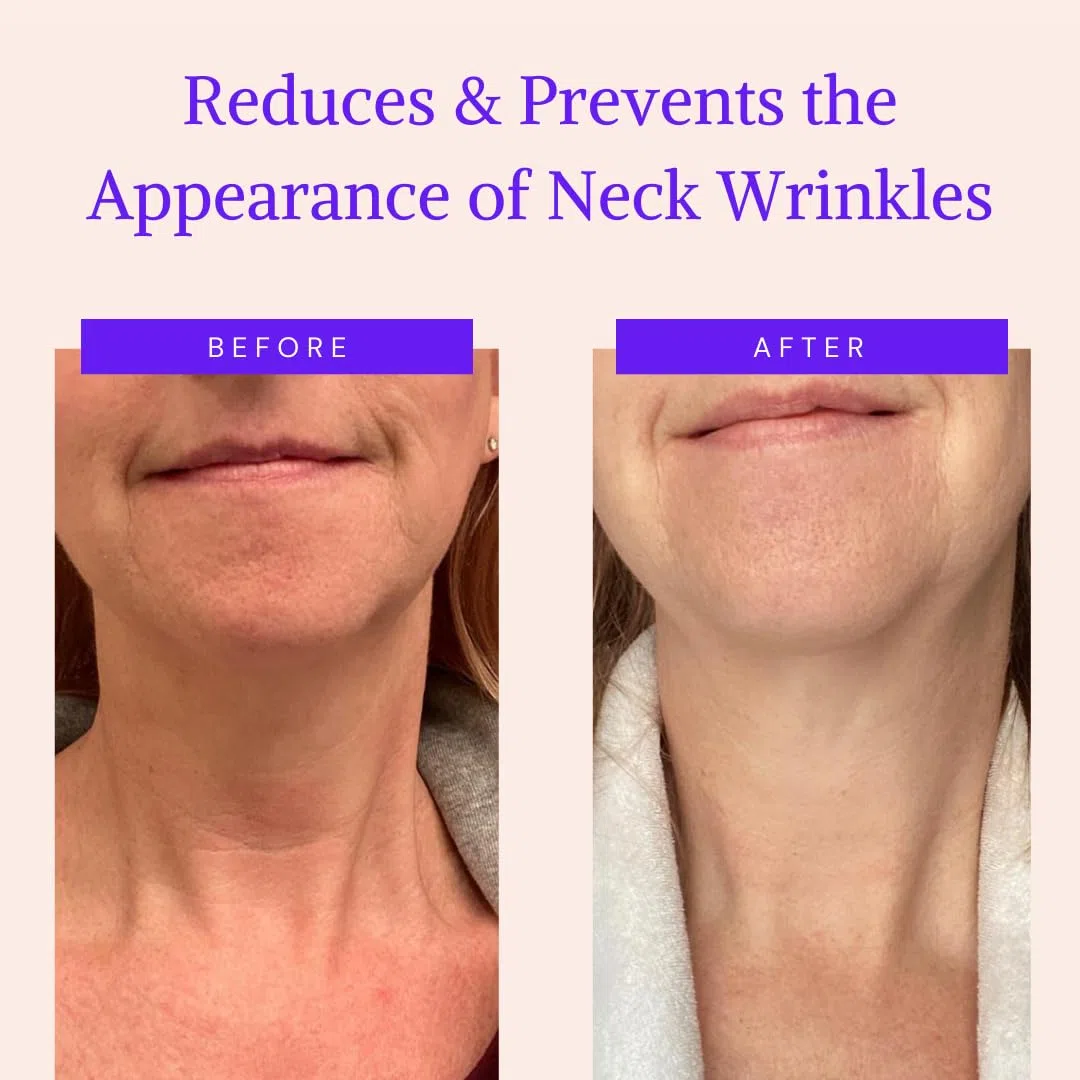 Almohadillas Antiarrugas para Cuello - Silicona Reutilizable para Arrugas del Escote - Prevenir y Eliminar Arrugas de Piel - Reafirmante, Tonificante, Más Natural Alternativa al Botox (Para 1 mes)